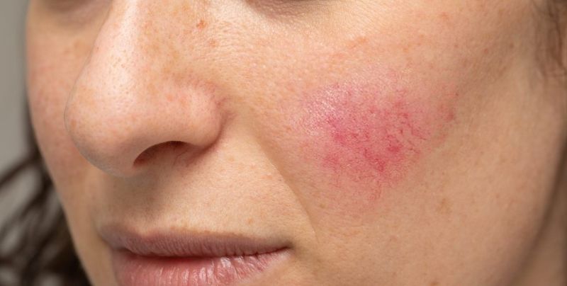 Mỹ phẩm không phù hợp khiến da bị ngứa, sưng, đỏ Mỹ phẩm không phù hợp khiến da bị ngứa, sưng, đỏ